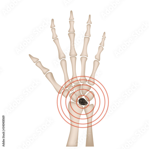 Kienböck's disease. Anatomy of the hand. Aseptic necrosis of the semilunar bone photo