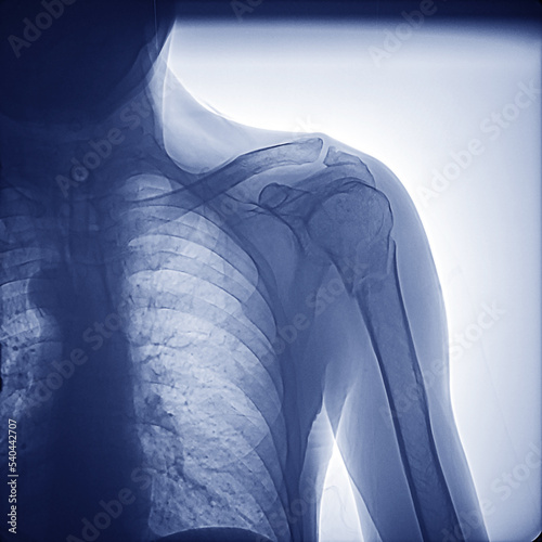 X-ray of the human shoulder joint. Fracture in the neck of the right humerus. Osteoarthritis of the acromioclavicular joint.