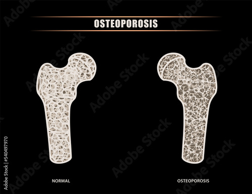Illustration of a human femur versus hip intra-articular comparison of normal bone symptoms with osteoporosis. For medical, educational and commercial use.