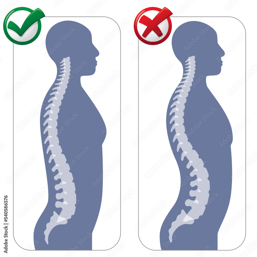 Human anatomy lumbar hyper lordosis illustration. Ideal for catalogues