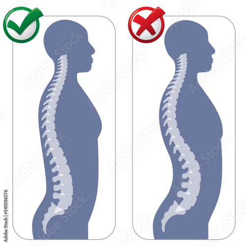 Human anatomy lumbar hyper lordosis illustration. Ideal for catalogues, newsletters and medical guides