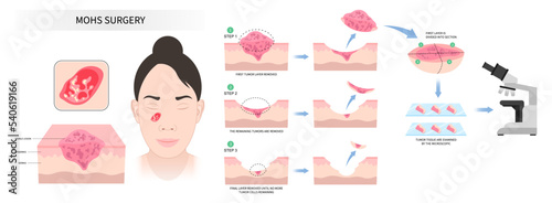 Microscopic Facial biopsy and Mohs surgery basal cell reconstruction for Paget's disease inflammation