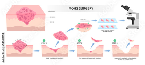 Mohs surgery basal cell microscopic reconstruction Paget's disease inflammation biopsy photo