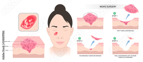Facial with Mohs surgery basal cell microscopic reconstruction Paget's disease inflammation biopsy