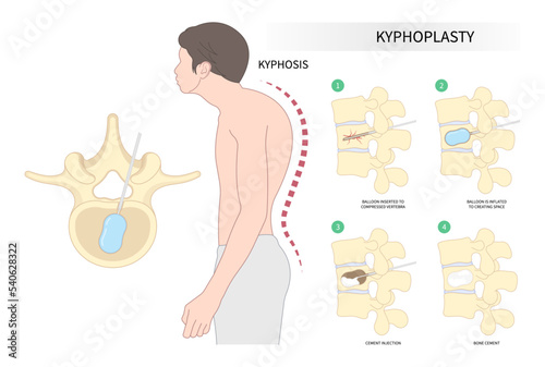 kyphoplasty spine of dowager’s hump disease posture hunched back bone disk joint neck pain surgical degeneration over backbone vertebral column photo