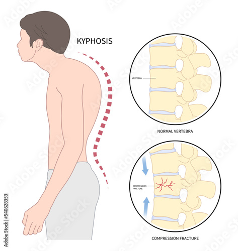 back and neck pain hunched bone posture with kyphoplasty spine of dowager’s hump disease disk joint surgical degeneration over backbone vertebral column