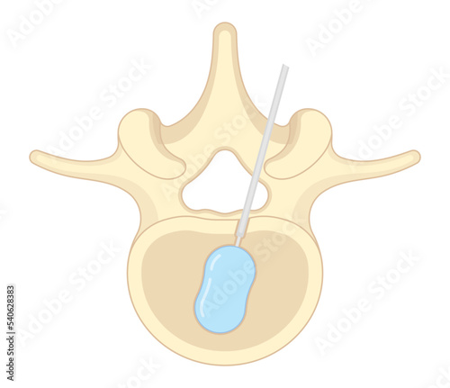 posture hunched back and vertebral column bone disk joint neck pain kyphoplasty spine of dowager’s hump disease surgical degeneration over backbone