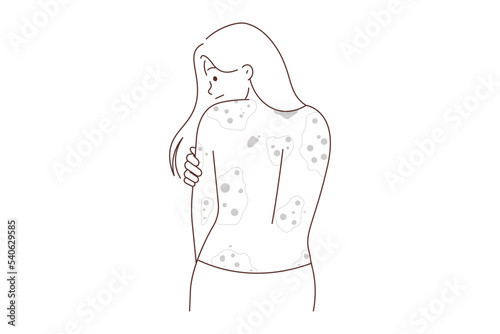 Unhealthy woman show red rash on back