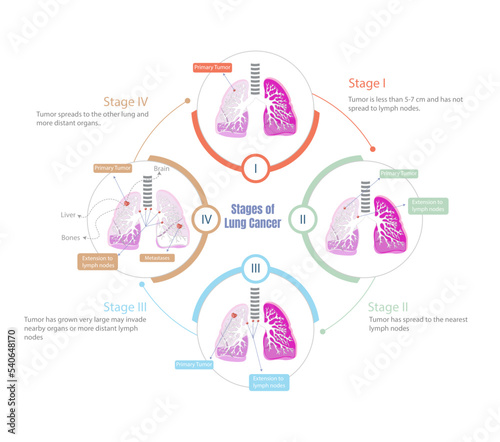Stages of lung cancer. Process of how it progresses in all its stages.