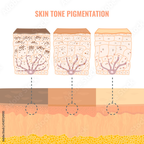 Melanin content and distribution in different skin phototypes. Pigmentation mechanism in dark, olive and light skin. Epidermis cross-section infographic medical diagram. Vector illustration. photo