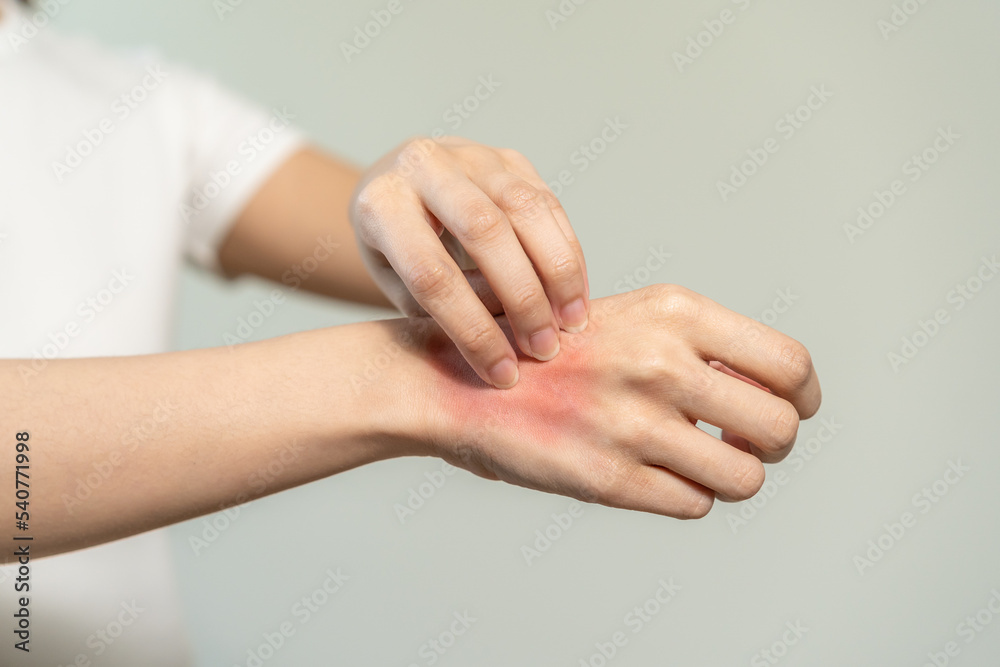 Photo & Art Print Dermatology asian young woman allergy, allergic ...