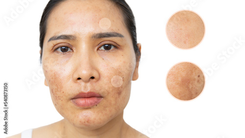 Close up of  women having skin problems on white background. W omen having damage skin burn after laser on her face