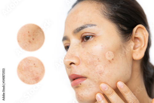 Close up of  women having skin problems on white background. W omen having damage skin burn after laser on her face