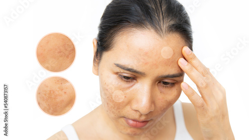 Close up of  women having skin problems on white background. W omen having damage skin burn after laser on her face