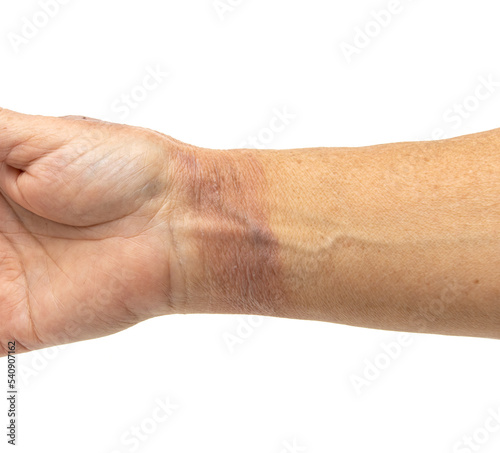 hot water burn on the skin of the hand