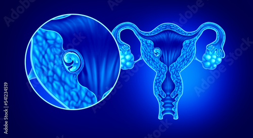 Implanted human embryo concept and successful pregnancy implantation in the uterus as a growing fetus in a female body as an obstetrics and gynecology symbol photo