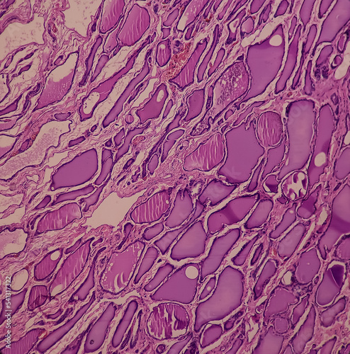 Multinodular goitre. Show thyroid tissue, follicles of different size and shape lined by flattened epithelium and containing colloid material,no malignancy present. photo