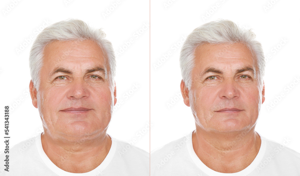 Double chin problem. Collage with photos of senior man before and after plastic surgery procedure on white background Double chin problem. Collage with photos of senior man before and after plastic surgery procedure on white background