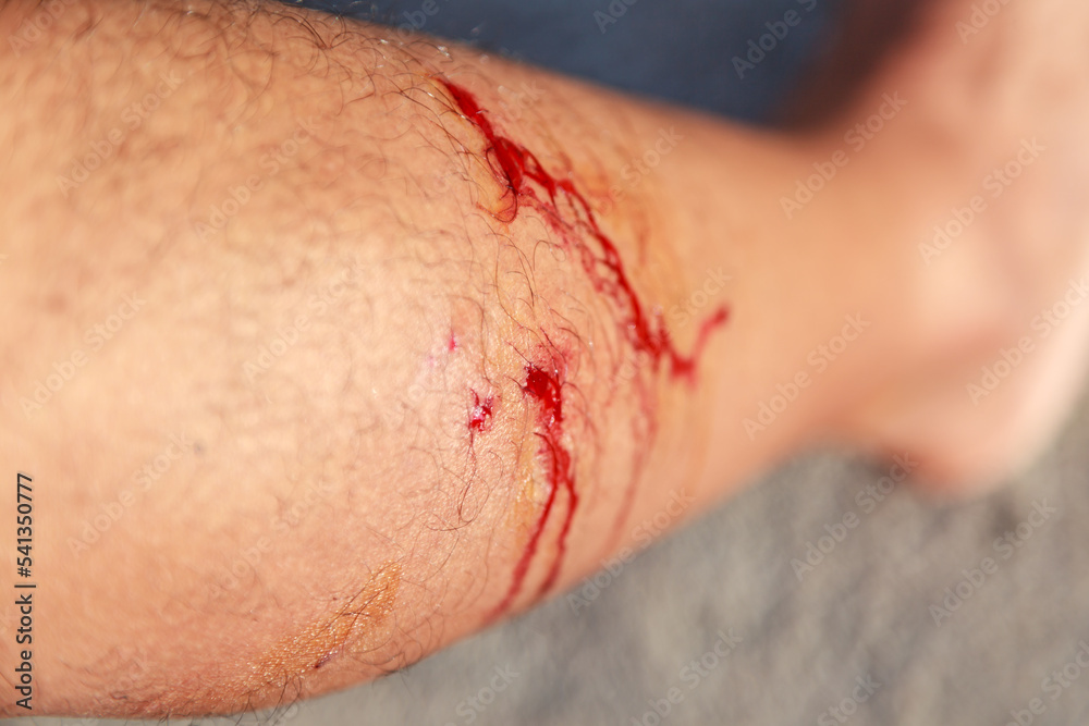 Fototapeta premium Dog bite wound on leg