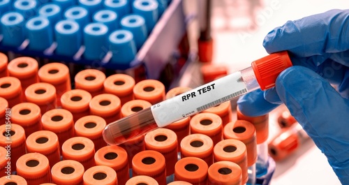 Rpr Test tube with blood sample in infection lab photo