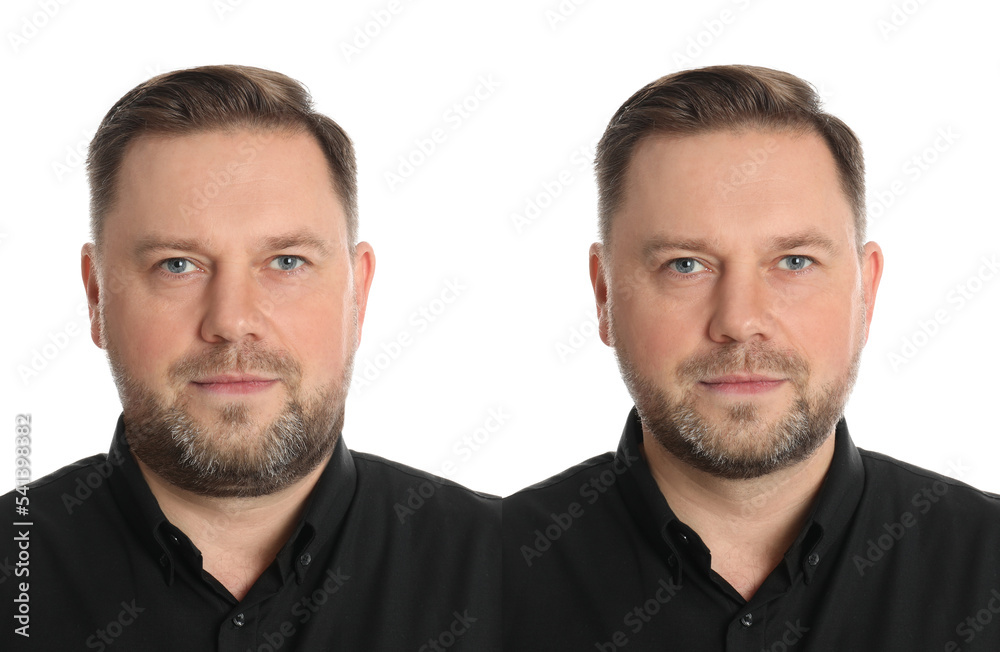 Double chin problem. Collage with photos of mature man before and after plastic surgery procedure on white background Double chin problem. Collage with photos of mature man before and after plastic surgery procedure on white background