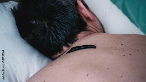 A leech sucks blood on the back of a patient in a hirudotherapy salon  photo