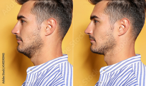 Double chin problem. Collage with photos of man before and after plastic surgery procedure on yellow background photo