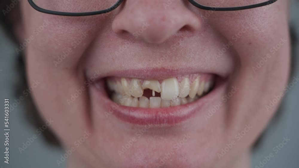 Smiling young caucasian woman with broken front tooth from which fiberglass pins sticking out. Tooth injury, chipped tooth half after accident. Dentistry and maxillofacial treatment. Dental trauma.