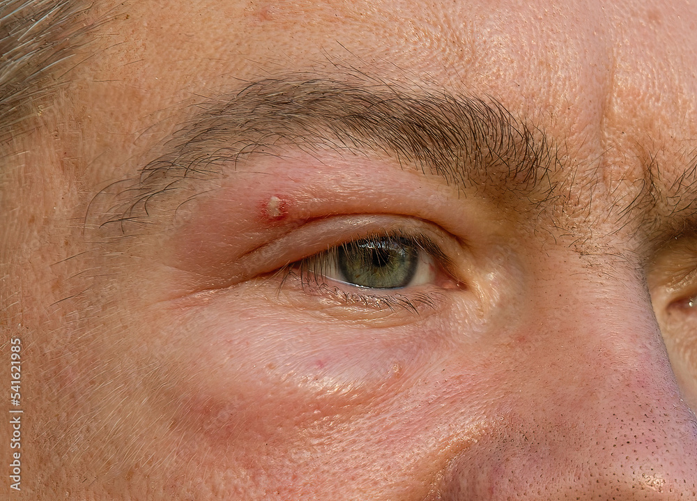 Fototapeta premium A man with a swollen eye from a bee sting. Swelling of tissue from bites.