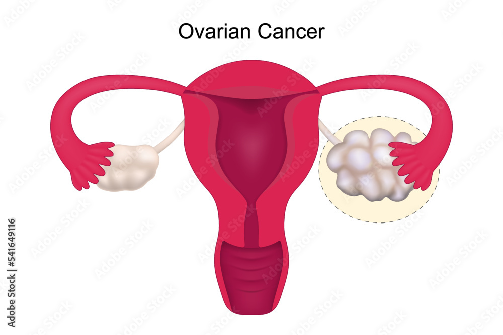 Ovarian cancer. Uterus anatomy. Female reproductive system vector ...