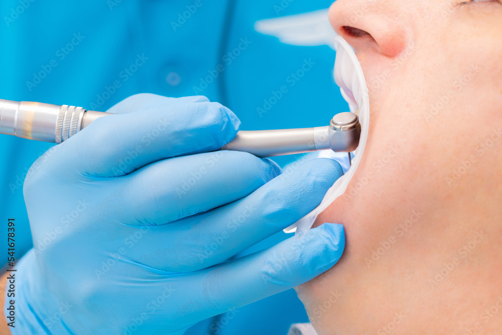 Close-up of a drill drilling a patient's teeth. retractor, saliva ejector. caries treatment Close-up of a drill drilling a patient's teeth. retractor, saliva ejector. caries treatment