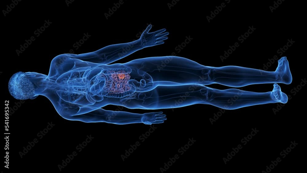 3d rendered medical animation of a small intestine tumor 3d rendered medical animation of a small intestine tumor
