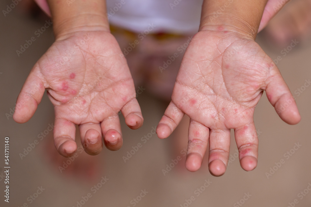 hand of a child with HFMD - obrazy, fototapety, plakaty 