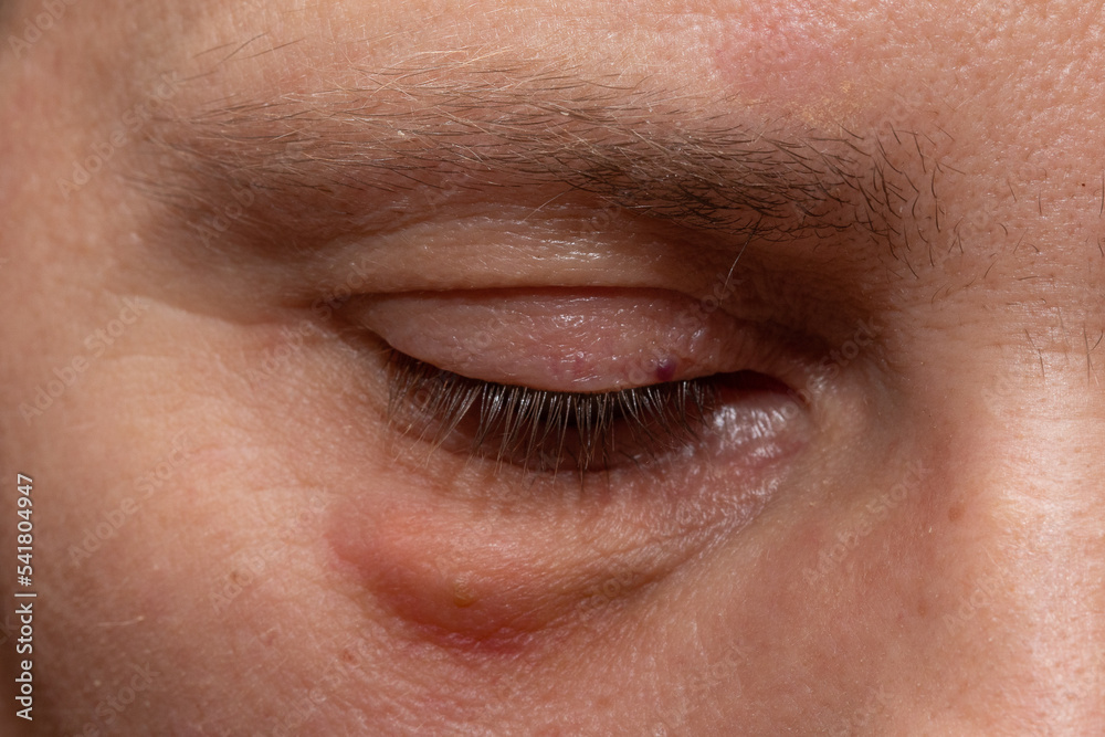 Fototapeta premium Swollen eyes from tiredness and irritation