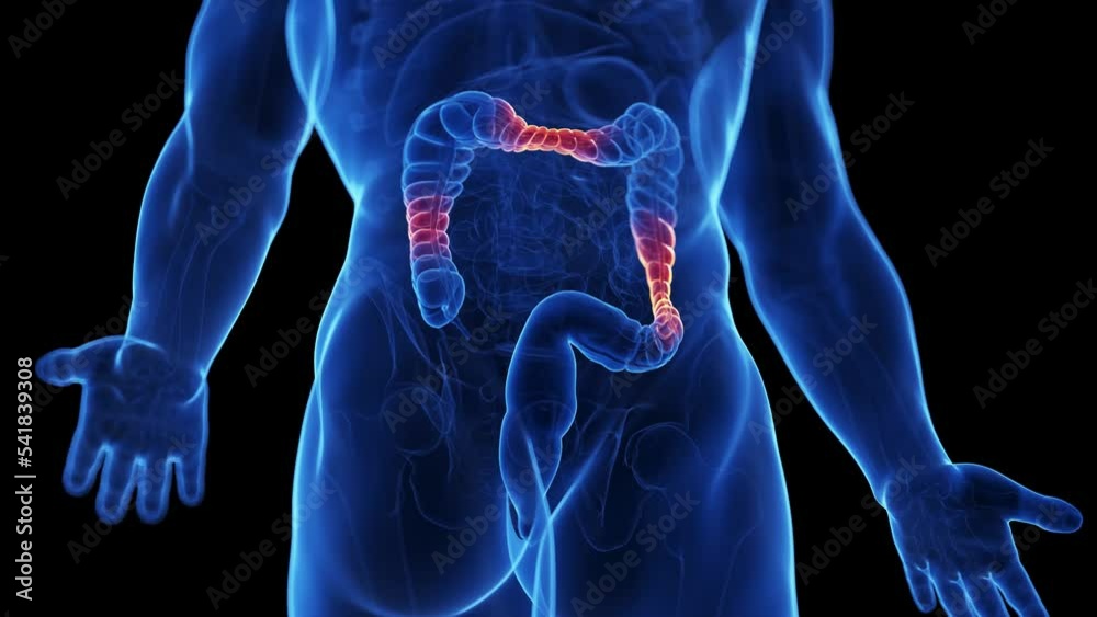 3d rendered medical animation of an irritable bowel syndrome
