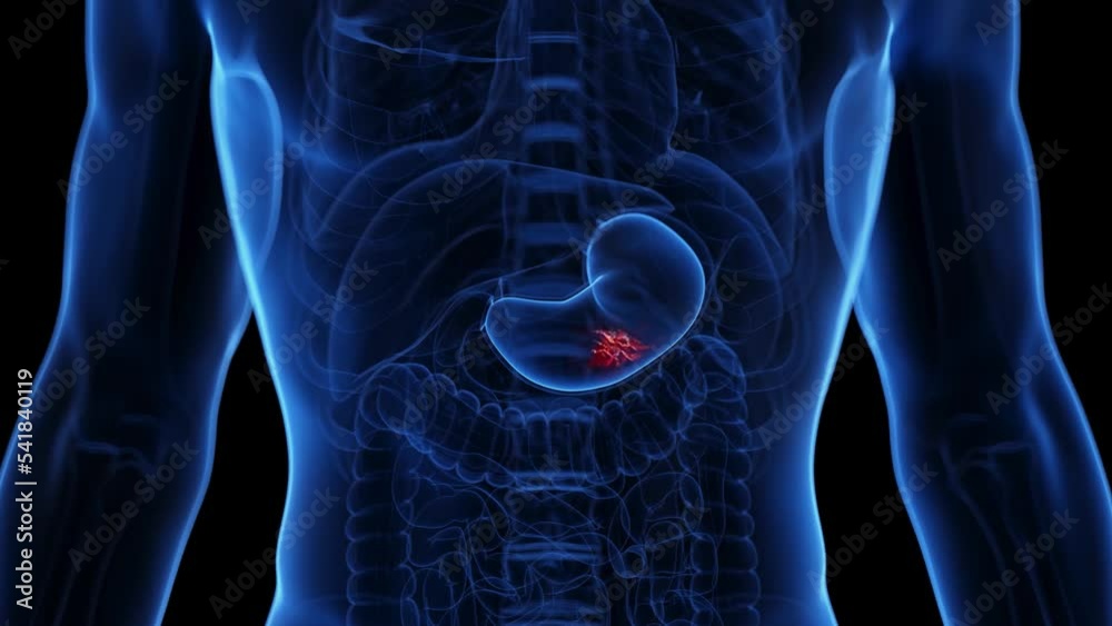 3d-rendered-medical-animation-of-a-stomach-ulcer-stock-video-adobe-stock