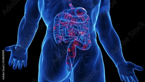 3d rendered medical animation of the colon of a man suffering from crohns disease photo