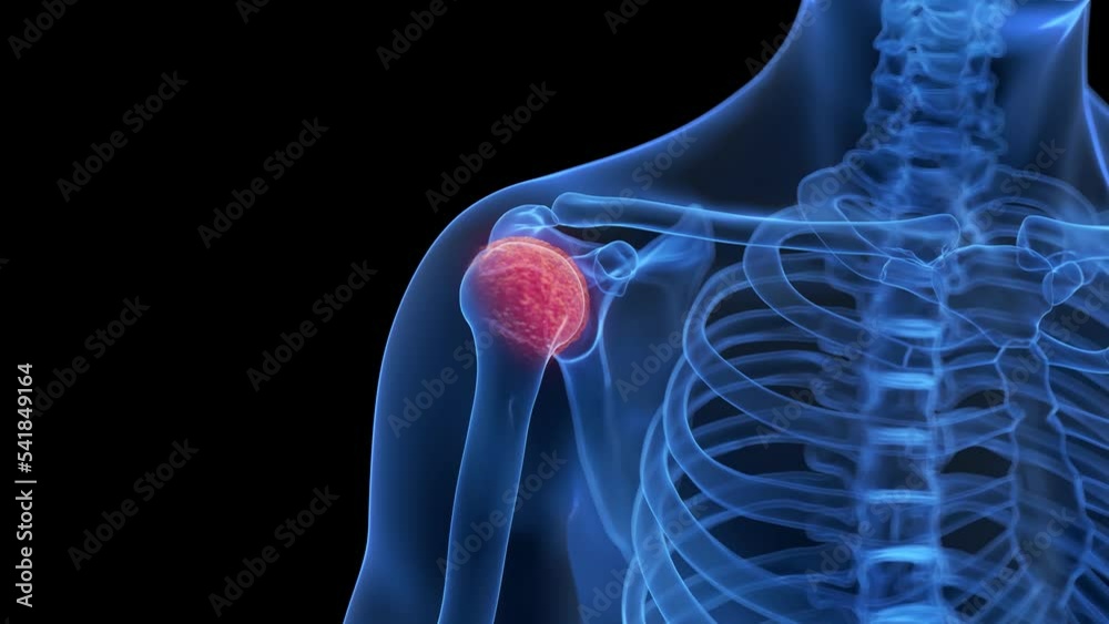 3d rendered medical animation of an arthritic shoulder Stock Video ...