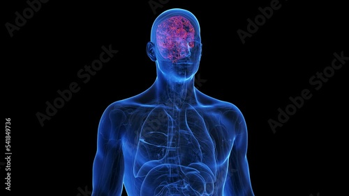 3d rendered medical animation of an infected brain