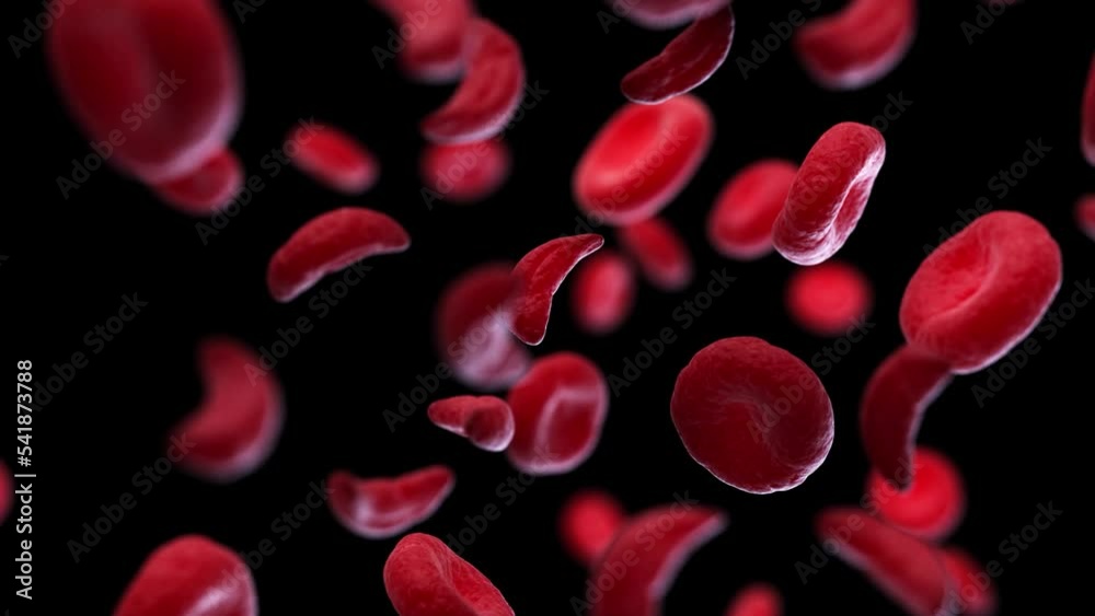 3d rendered medical animation of he sickle cell syndrome