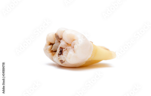 Close-up of a tooth with caries isolated on a white background. Removed wisdom teeth. Sick human teeth.