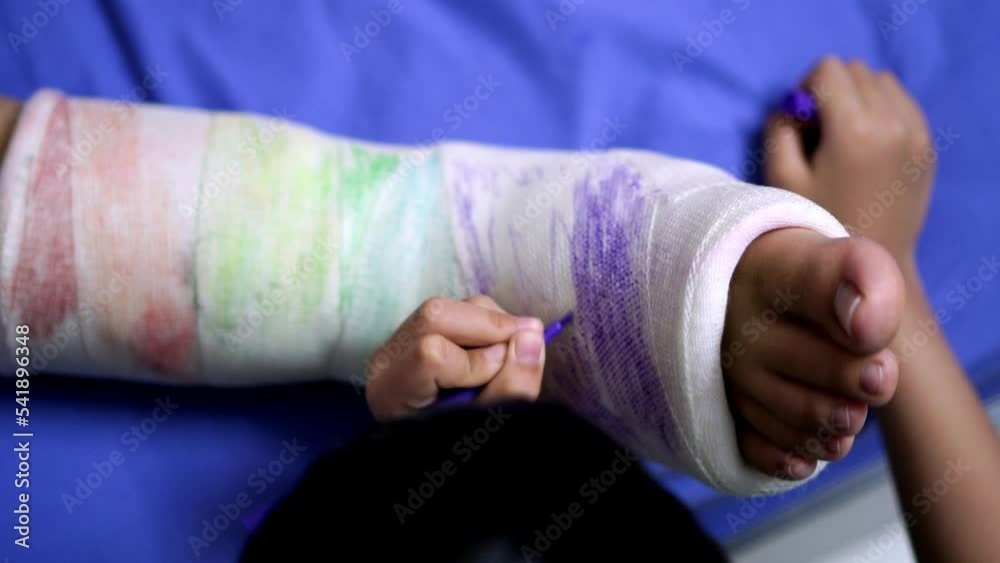 Daughter coloring purple at gypsum of mother. Stock Video Adobe Stock