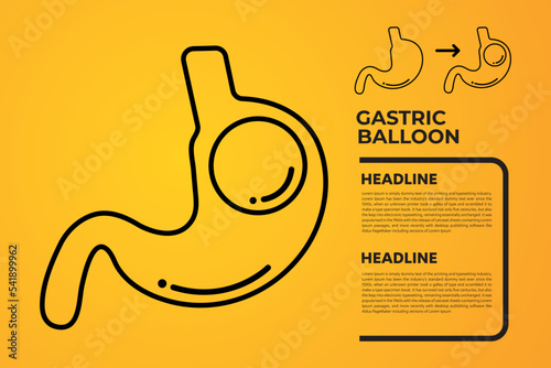 Stomach Endoscopy Gastric Balloon Inside a Stomach weight loss surgery vector illustration obesity 
