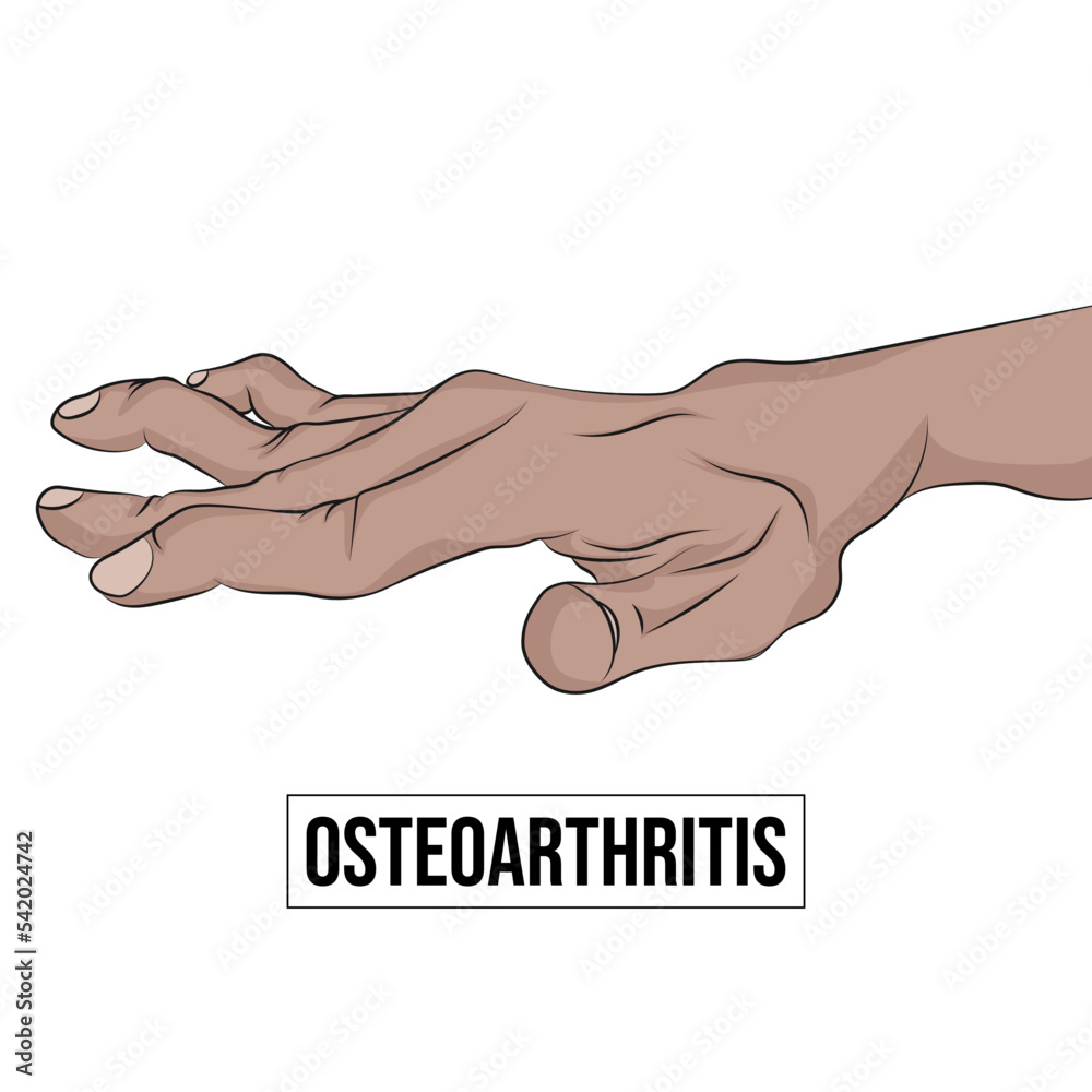 Osteoarthritis or osteoarthritis is the most common degenerative joint