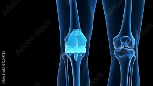 3d rendered medical animation of a knee replacement