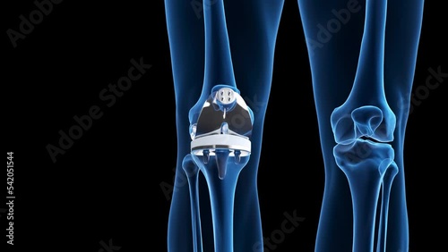 3d rendered medical animation of a knee replacement