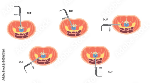 Lumbar Interbody Fusion (LIF). Spine surgery performade by a endoscopy technique. Different positions. ALIF, TLIF, OLIF, DLIF and PLIF 