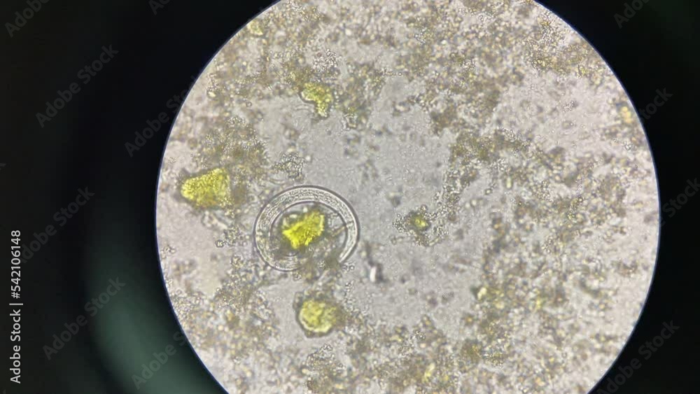 strongyloides stercoralis larva in stool exam finding with microscope