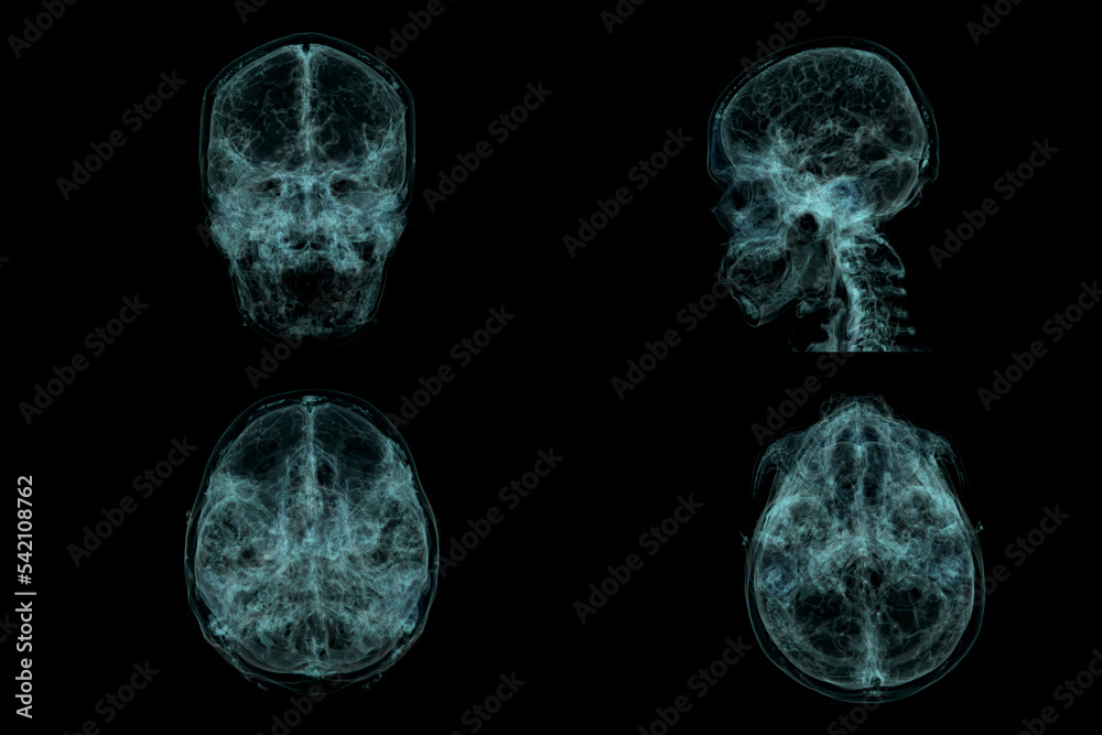 Human Skull, Brain by CT Scan. X-ray Visualization Inside Of Skull. 3D