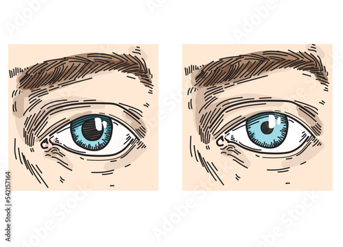 different size of pupils anisocoria eyes compare look face illustration line drawing on white background